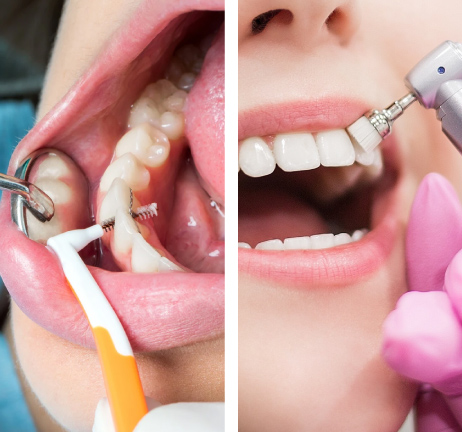 TEETH CLEANING IN ALWARQA DUBAI