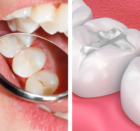 DENTAL FILLINGS IN AL WARQA