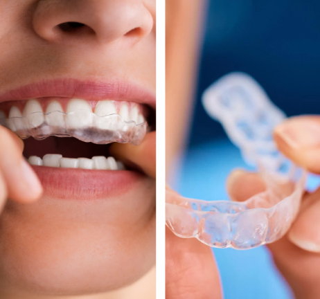 CLEAR ALIGNERS IN AL WARQA