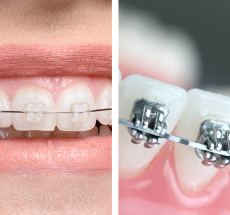 METAL & CERAMIC BRACES IN AL WARQA