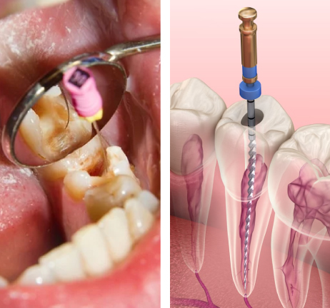 ROOT CANAL TREATMENT IN AL WARQA