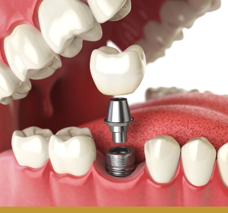 Dental Implants in Al Warqa