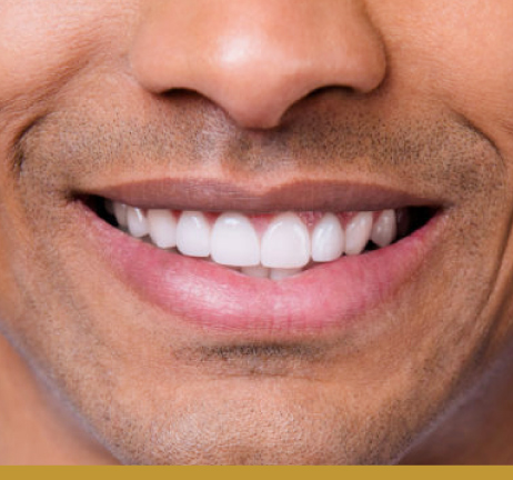DENTAL VENEERS IN AL WARQA