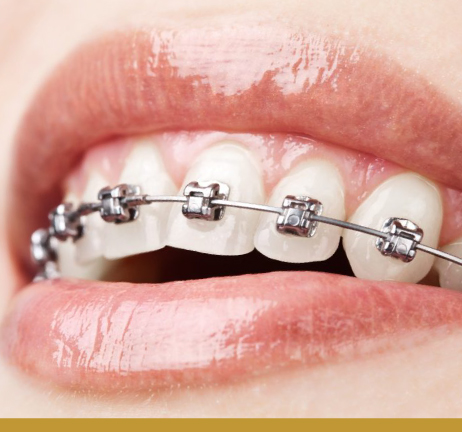 SELF-LIGATING BRACES IN AL WARQA