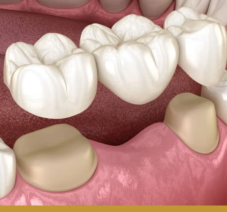 DENTAL BRIDGES & CROWNS IN AL WARQA