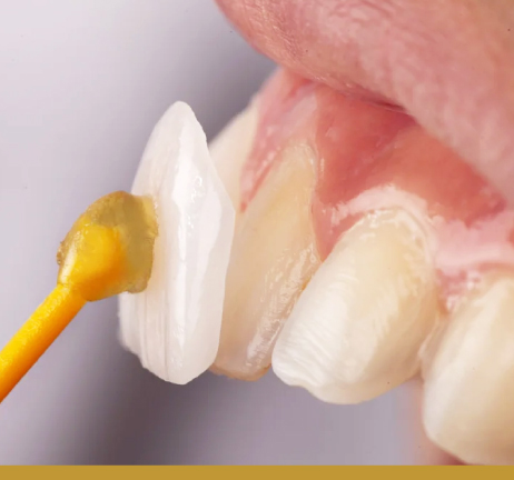 DENTAL VENEERS IN AL WARQA
