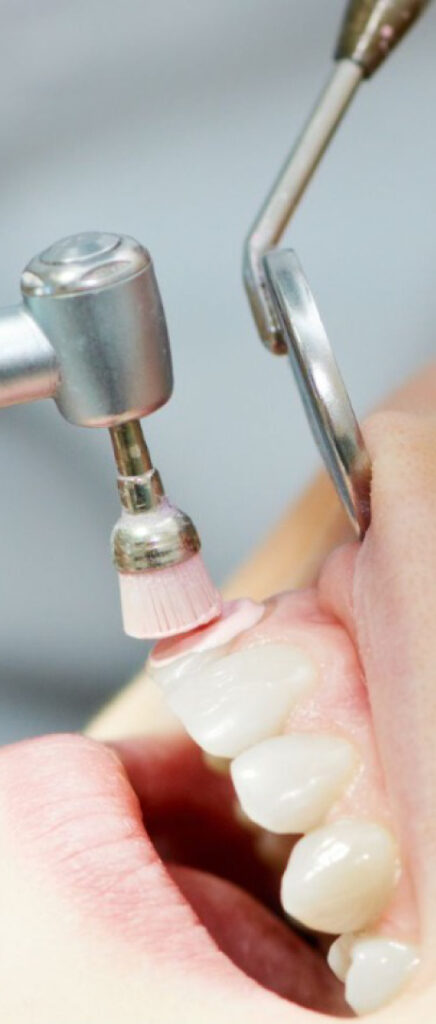 TEETH CLEANING IN ALWARQA DUBAI
