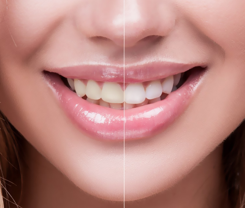 TEETH WHITENING IN AL WARQA