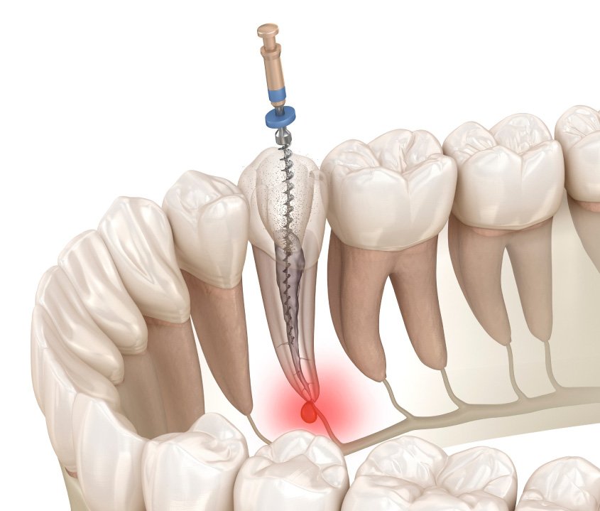 ROOT CANAL TREATMENT IN AL WARQA